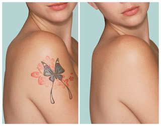 laser-tattoo-removal-3